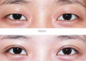 双眼皮的常见描述及其潜在影响