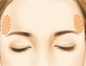 如何有效改善太阳穴凹陷，恢复饱满面部轮廓？