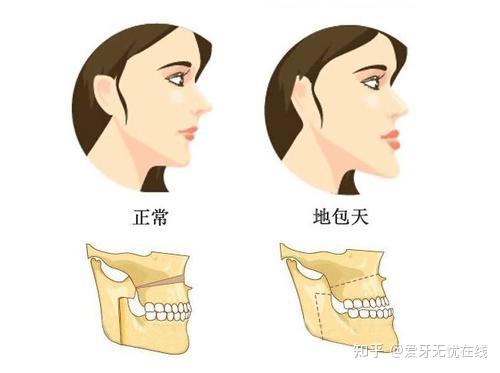 地包天的定义与成因