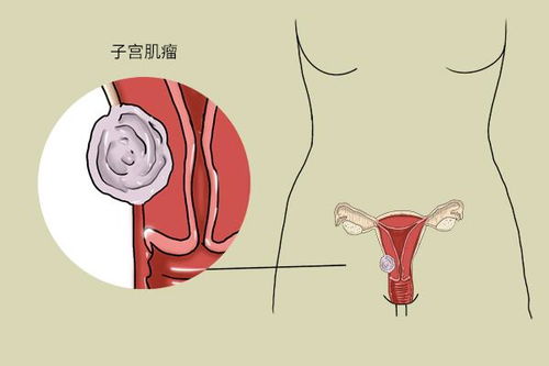 内分泌失调：月经颜色异常的常见原因