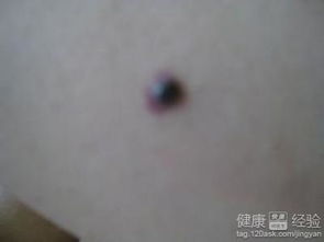 黑痣分布与黑色素瘤风险