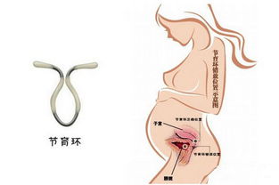 取环手术需要更多较长时间段？