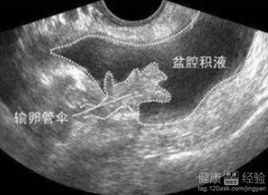 盆腔积液的有效医治方法