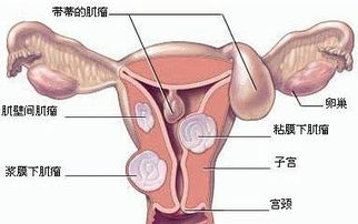 医治子宫壁厚， 你需要了解这一些