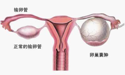 卵巢较大较小的改变：一个令人着迷的话题