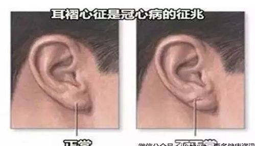 一、 耳垂：耳褶心征的警示