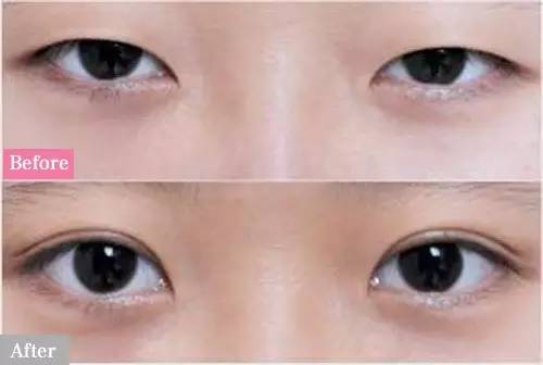单双眼皮的情感特征解析