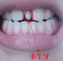 3. 小巧上下颚及小心眼倾向