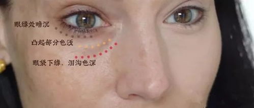 二、 卧蚕与眼袋的区别