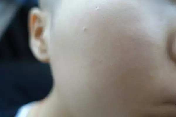 祛除凶痣的医学考量与美容服务的伦理边界