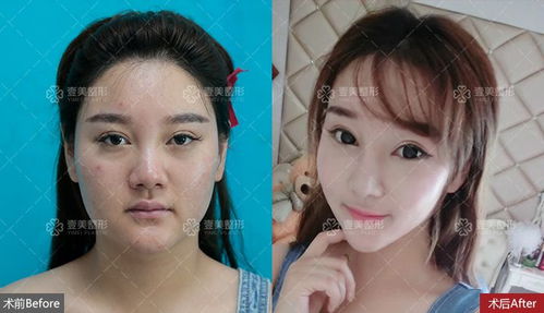 面部中庭留白过多如何改善面相？