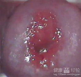 了解宫颈糜烂：不只是表面现象
