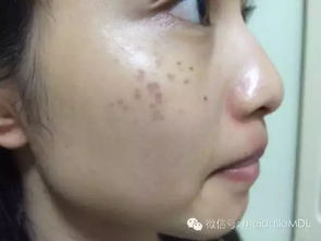 一、 痣之形色与位置的基本分类