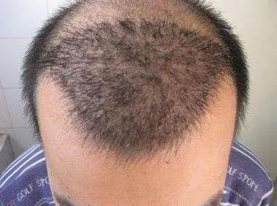 五、 临床案例分析及治疗建议