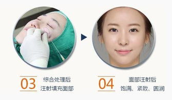 2. 填充疗法与组织容积的重建