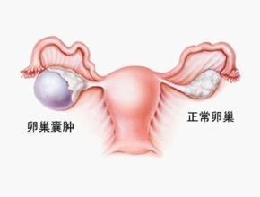 怎样判断有没有是(卯/巢嚢肿)(引|起)(的)(月经推迟)??