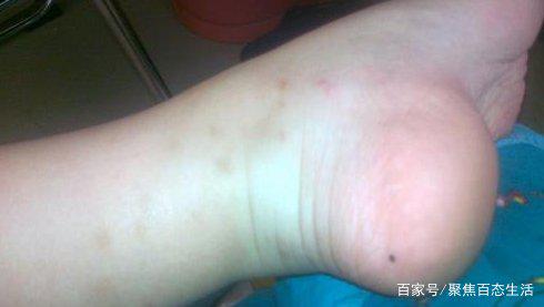 一、  脚侧面及脚踝长痣：劳碌命格与坚韧性格的辩证统一