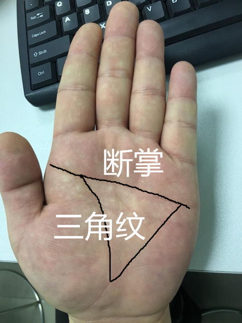 一、 断掌的定义及其形成