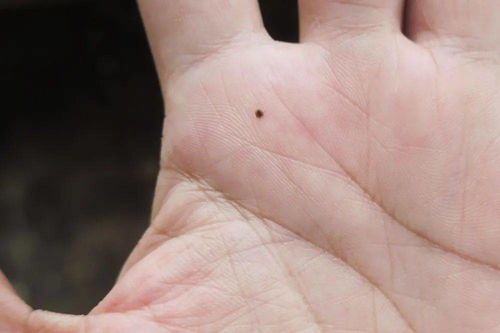 手心小红点手相变痣，手相会改写吗？