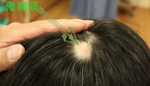 我为什么会梦见掉头发秃了好几块？