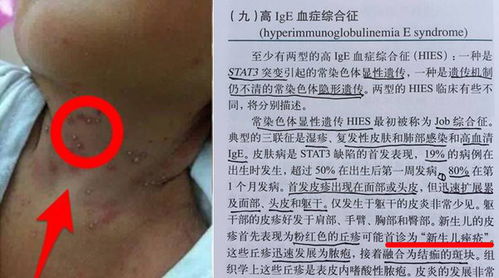 1.1 致敏原与IgE介导机制