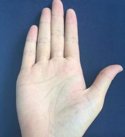 2.1 手掌柔软且中心出现凹陷