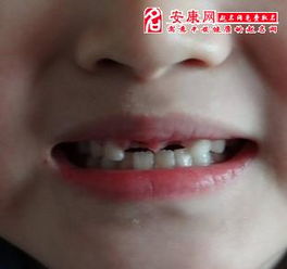 梦见自己的下门牙掉了一颗，预示着什么征兆或含义？