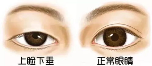 1、纯粹的单眼皮