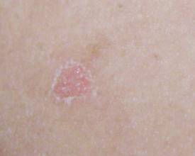 1.2 酸性物质对皮肤屏障的直接刺激