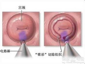 意外怀孕与宫颈炎