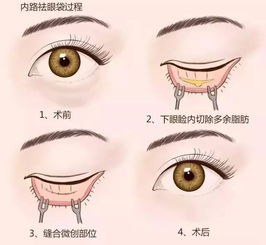 如何有效去除或淡化眼睛下八字纹？