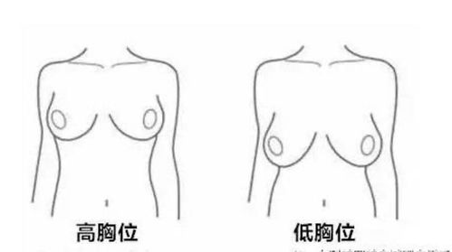 男性八字胸与正常胸型有哪些具体区别？
