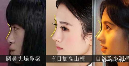 案例一：周冬雨与较小眼睛+塌鼻子的审美逆袭