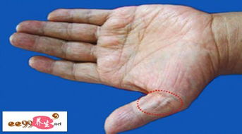 手掌色泽与形态的病理学分析