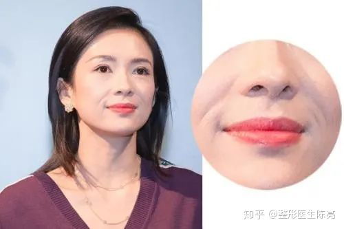 二、 法令纹形成的病理生理机制