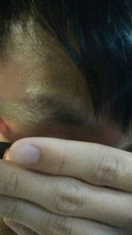 眉毛剃掉一半是哪种组织结构？原因及解决方法是什么？