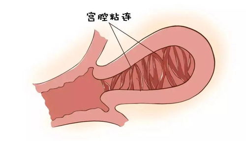 宫腔粘连与内膜异位症