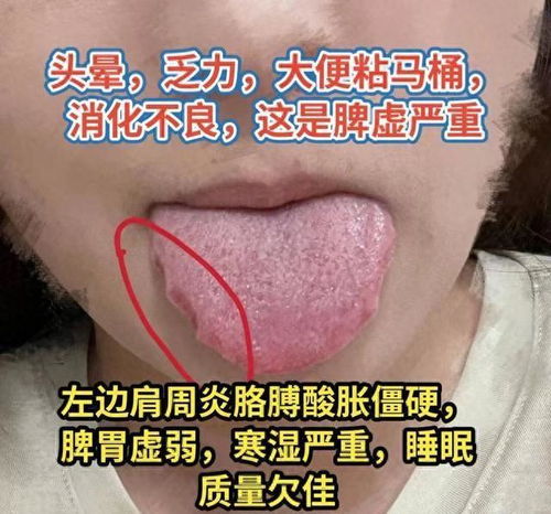 1. 穿心舌：阴虚伤津的体现