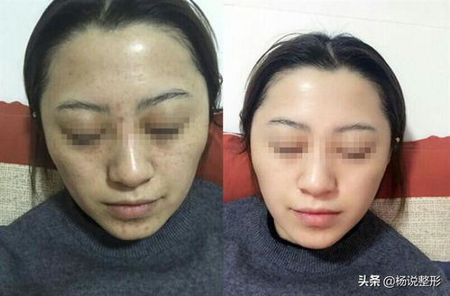 鼻梁的高度与协调性