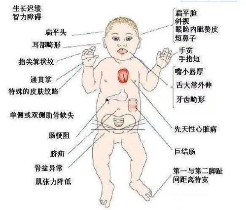 唐氏儿， 一个沉沉重的家庭生活负担