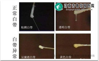 正常状态下的白带：清爽透明是标配