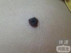 2.2 年龄增长与皮肤老化