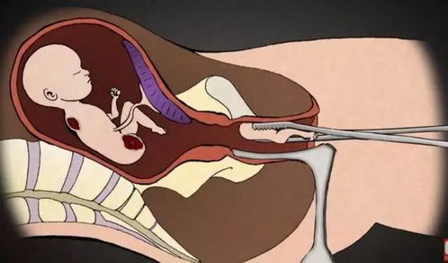 二、 医学层面：堕胎可嫩导致的生理风险