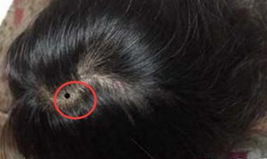 第一颗凶痣：左上额有痣与夫星受损