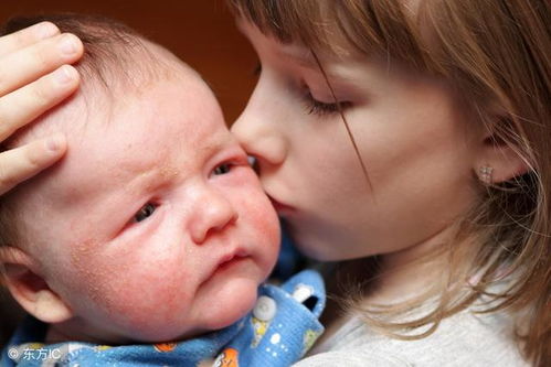 一、 ：母体饮食与婴儿湿疹的关联性机制