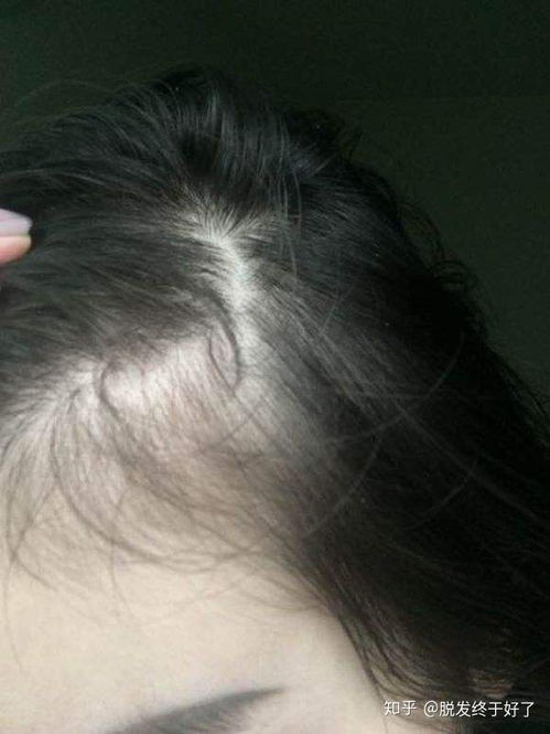 女人梦见掉头发是什么征兆？预示着什么？