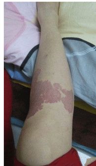 1. 大腿内侧胎记——低调内敛之富贵