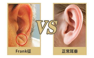 1.2 耳垂丰满与旺夫之说