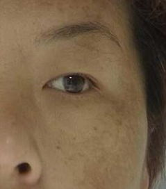 三、 缓慢性炎症：皮肤的“隐形炸弹”