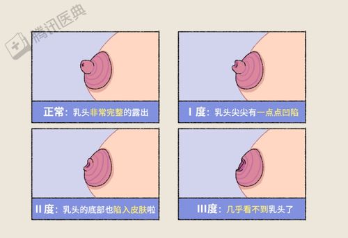 乳晕变大疙瘩是什么原因引起的？